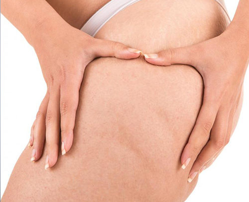 limclinic-and-surgery-cellulite-trreatment