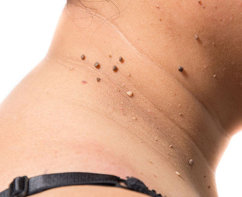 limclinic-and-surgery-mole-warts-skintags