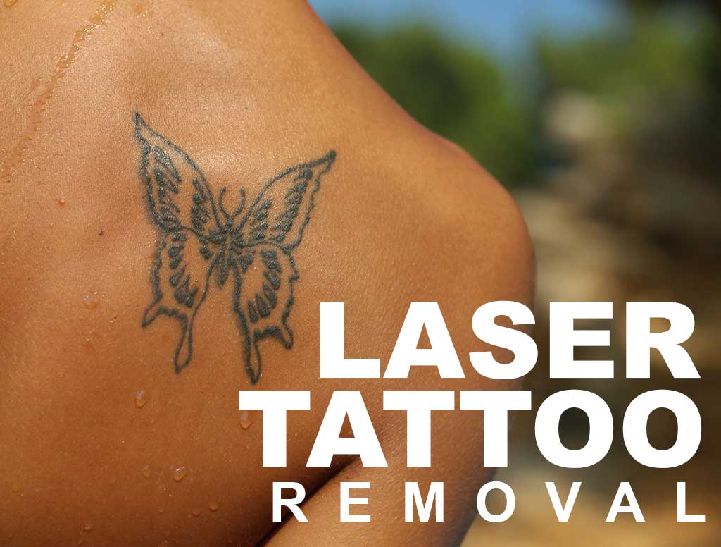 Spectra Nd Yag Laser for Tattoo Removal Singapore Lim